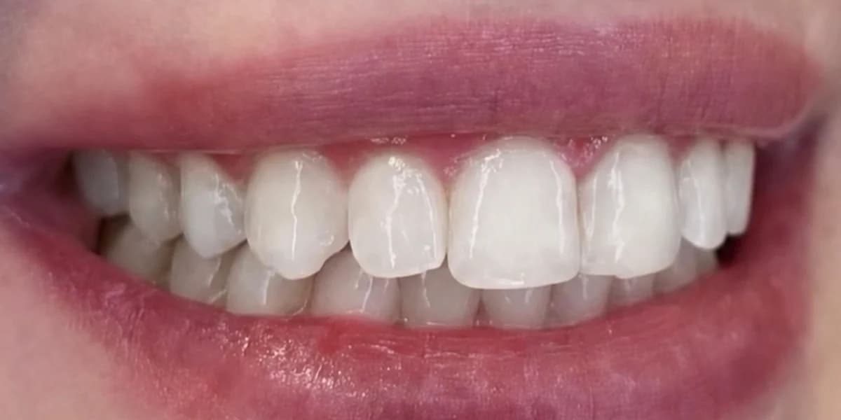 A client's smile after one whitening session