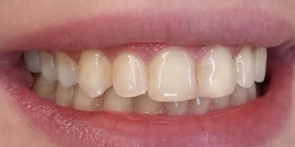 The same client's smile before whitening
